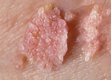 lesão condilomatosa vulvar