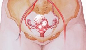 Miomas uterinos: tumores benignos na parede do útero podem ser retirados por miomectomia ou ser realizada a histerectomia