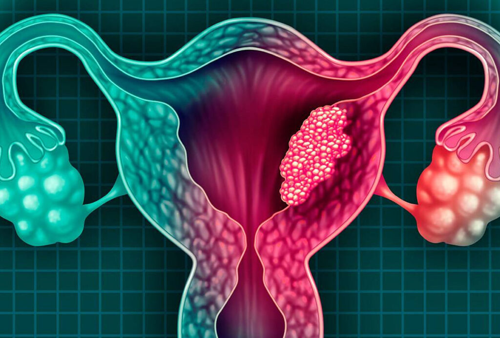 As cirurgias uterinas são realizadas por cirurgião ginecológico bem qualificado e com experiência. É extremamente importante que você procure por um especialista para ter um bom resultado e uma melhor qualidade de vida após o procedimento. Com certeza somente esse profissional vai lhe dar a melhor indicação cirúrgica.