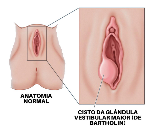 Cisto de Bartholin ou Bartolinite? Entenda Causas e Tratamentos.